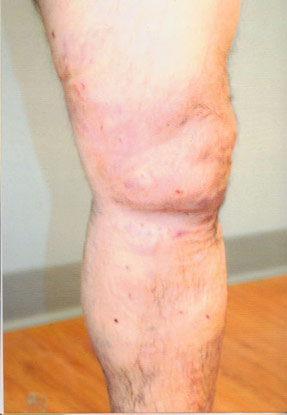 varicose laser vein removal ventura dr hanna