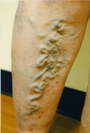 varicose laser vein removal ventura dr hanna