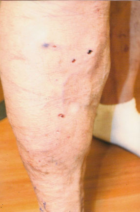 varicose laser vein removal ventura dr hanna