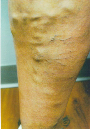 varicose laser vein removal ventura dr hanna