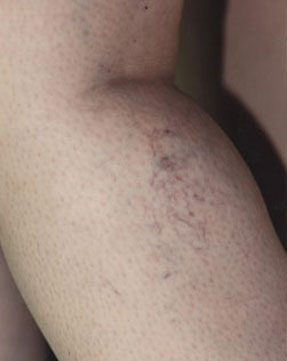 varicose laser vein removal ventura dr hanna