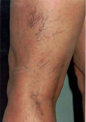 spider laser vein removal ventura