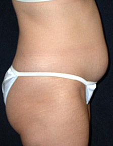 Vaser Lipo before