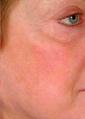 Laser Vein Removal - Face