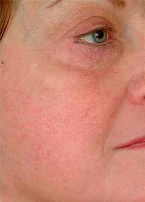 Laser Vein Removal - Face