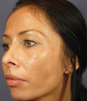 VI Peel acne before after la nouvelle medical spa
