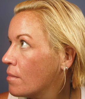 VI Peel sun damage before after la nouvelle medical spa